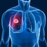 Nuovo test: la diagnosi precoce del tumore del polmone guadagna due anni