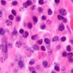 Mieloma multiplo: una nuova strategia per indurre la morte programmata delle cellule tumorali